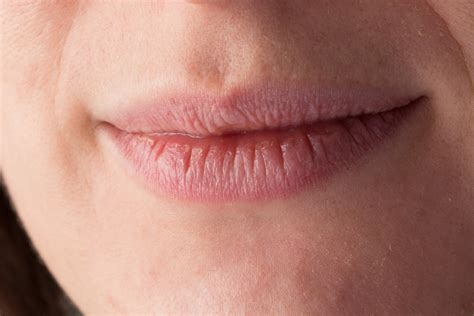 Why Is The Skin Around My Lips Dry And Red | Lipstutorial.org