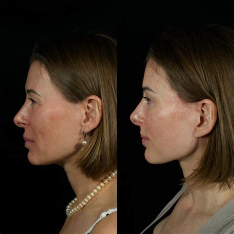 lip lift   patient  roskies