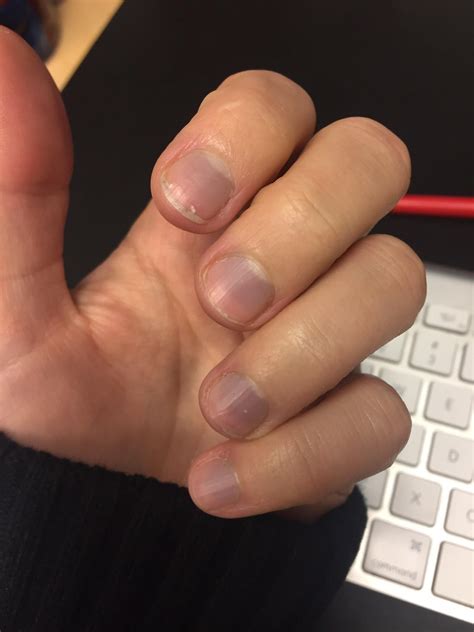 What Does Having Purple Nail Beds Mean at Timothy Sapp blog