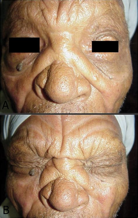 lion face syndrome