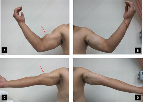 Popeye’s sign: biceps tendon rupture | BMJ Case Reports