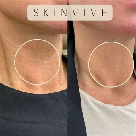 Skinvive Antes E Depois