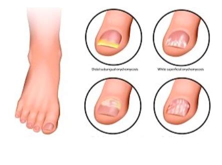 Top Tips for Preventing Toenail Problems — Precision Foot and Ankle Centers