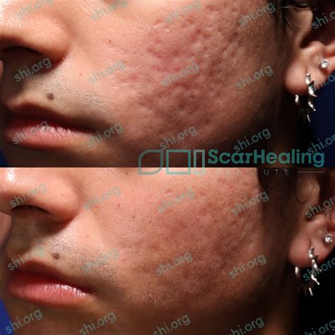 Scar Healing Institute: 2024 Leading Pioneers of Scar Treatment