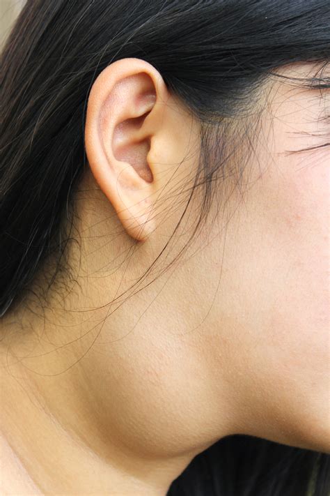 Cancerous Cyst On Neck