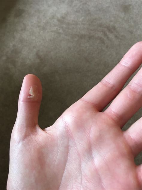 Best way to get rid of blister before round tomorrow? : r/golf