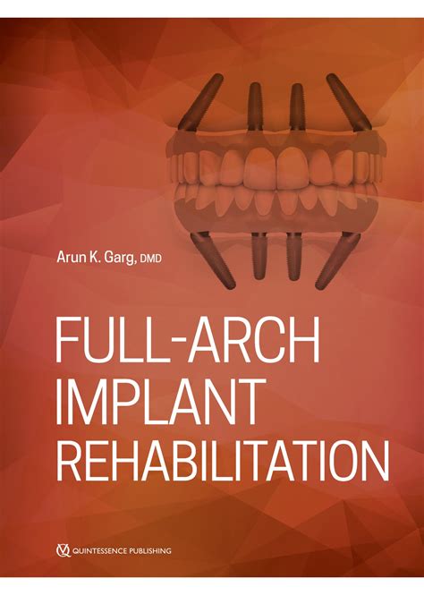 Full-Arch Implant Rehabilitation – Mi-tec Medical Publishing