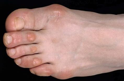 hard blister  bump  bottom  foot discount emergencydentistrycom
