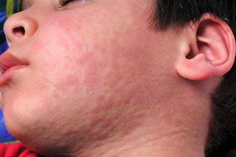 Alergia A Amendoim Fotos - 5 sintomas da alergia alimentar: saiba os mais comuns para agir rapidamente