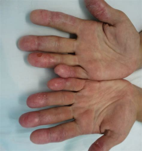 Sporotrichosis: Diagnosis and Management | Consultant360