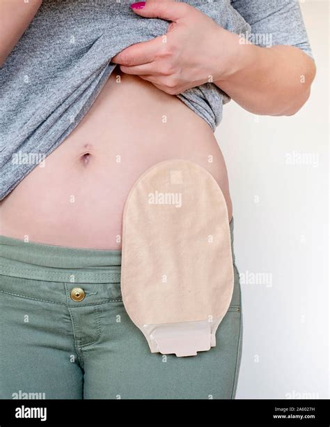 Colostomy Bag High Resolution Stock Photography and Images - Alamy