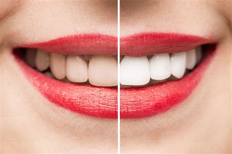 8 Ideal Teeth Whitening Items