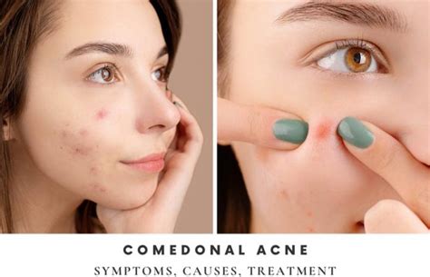 comedonal acne symptoms  treatment  tips