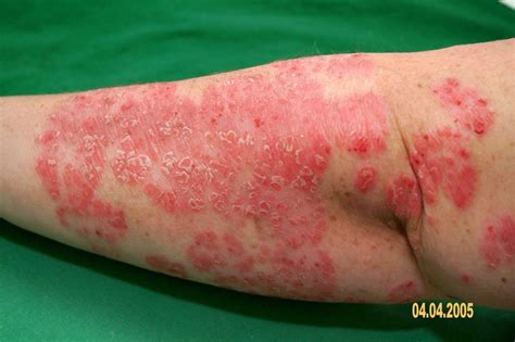 Dermatologija | Naftalan