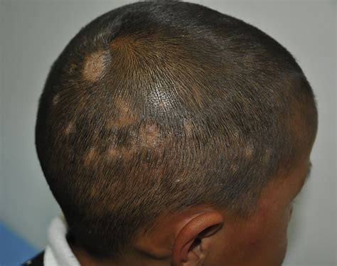 Ultraviolet dermoscopy for the diagnosis of tinea capitis - Journal of ...