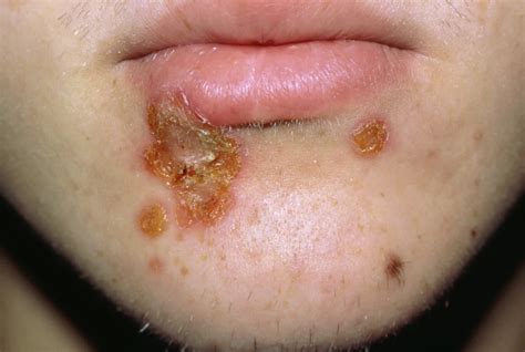 itchy blister rash pictures   treatment