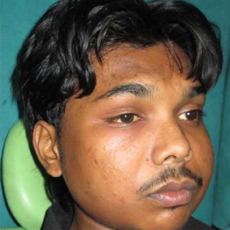showing swelling  left cheek  scientific diagram