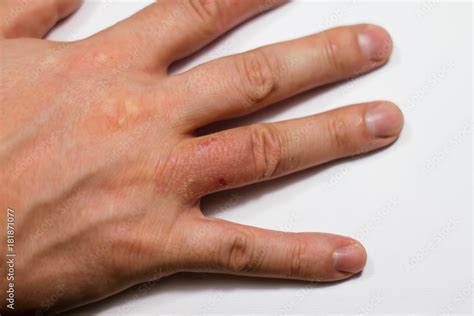 Hand dermatitis. Hand eczema Stock Photo | Adobe Stock