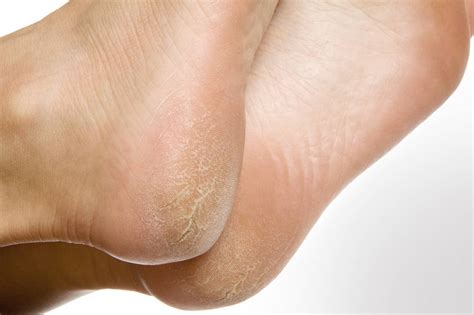 heel problems premier foot ankle center  stars oakbrook podiatrist