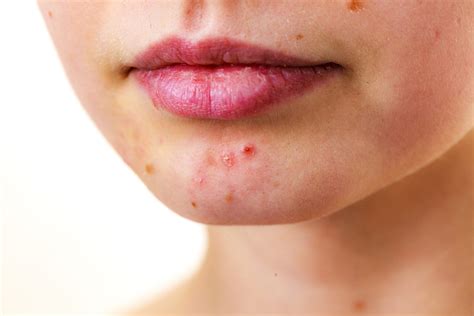 Why is my skin breaking out? Causes and fixes for sudden acne- mamabella