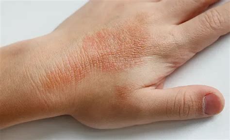 5 Common Eczema Triggers | Dermatology & Aesthetics located in Brooklyn ...