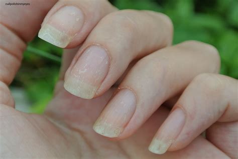 Ridges In Nails Eczema at Geraldine Fellows blog