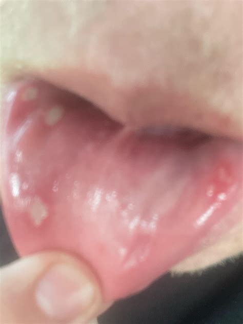 Can Vaping Cause Canker Sores - EMSEKFLOL.COM