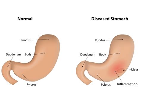 Can Gastritis Cause Gas Pains at Kyle Schalk blog