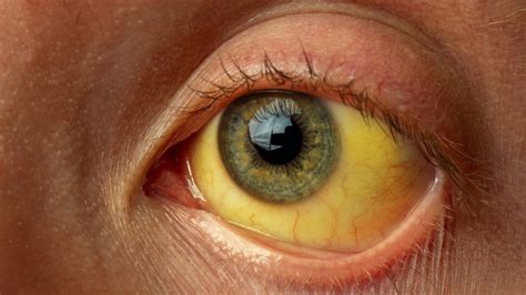 Jaundice: Signs, Causes And How You Can Prevent? - Health 24