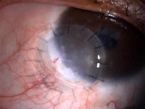 presence  left eye inferonasal limbal dermoid  post limbal