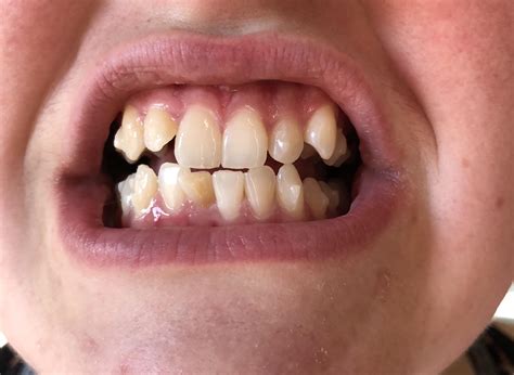 How Long Do You Have To Wear Invisalign In A Day / How Long Can You
