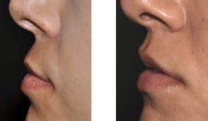 A Modified Subnasal Lip Lift for Columellar Retraction - Explore Plastic Surgery