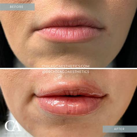 Lip Injections Before After | Chicago Aesthetics Med Spa