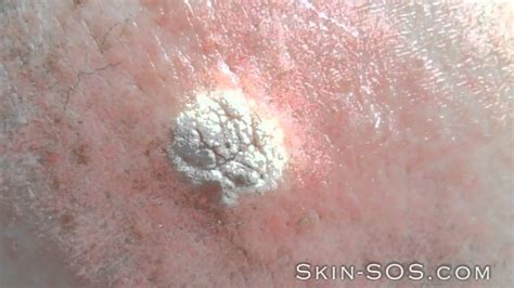 lemon oil  solar keratosis burns      answernow