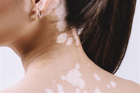 Vitiligo – Sharp Vision Hospital