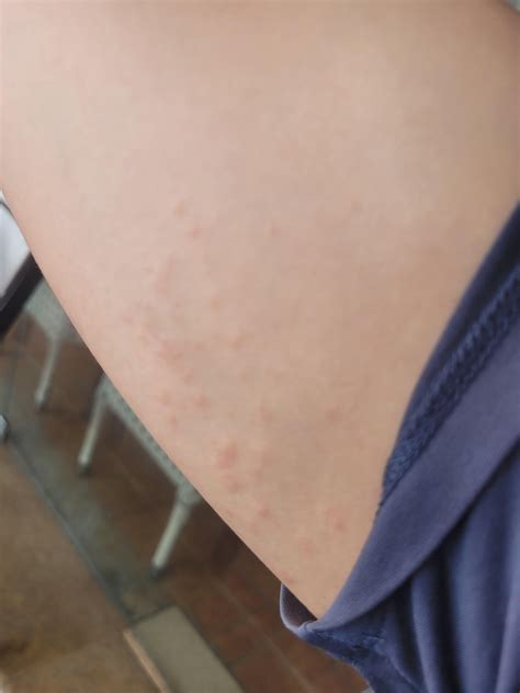 Rash/pimples? On same location on both arms: inside triceps : r