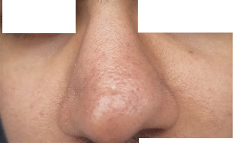 Nose swelling. Could this be rhinophyma? Any recommendations? : Rosacea