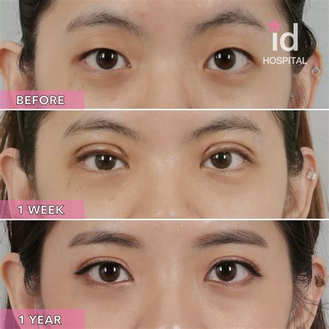 double eyelid procedure    id hospital korea monolid