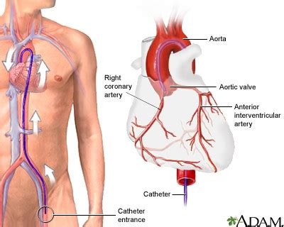 Coronary Angiography/Cardiac Catheterization - The Cardiac Institute