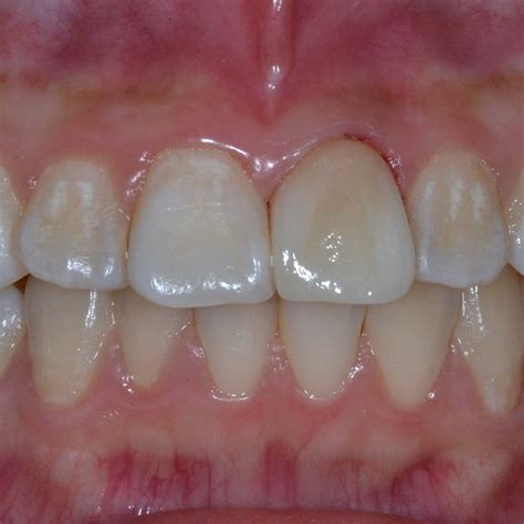 la ricostruzione gengivale  milano