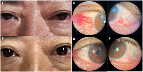 frontiers case report carotid cavernous fistula presenting  red