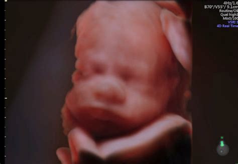 Ultrasound Specials for scans | Love at First Sight Ultrasound