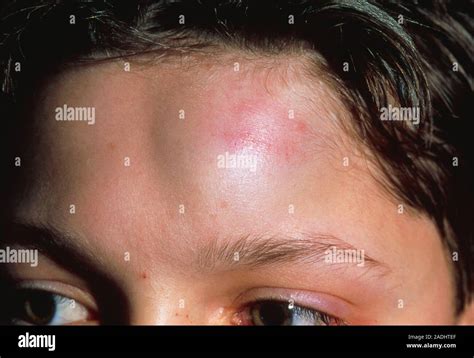 forehead injury close   swelling   forehead due  blunt