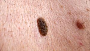 Keratoma removal - Esteva Clinic