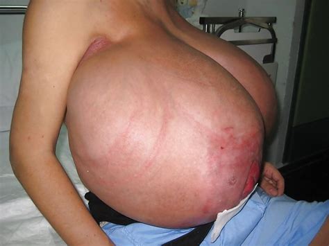 Macromastia - 19 Pics | xHamster