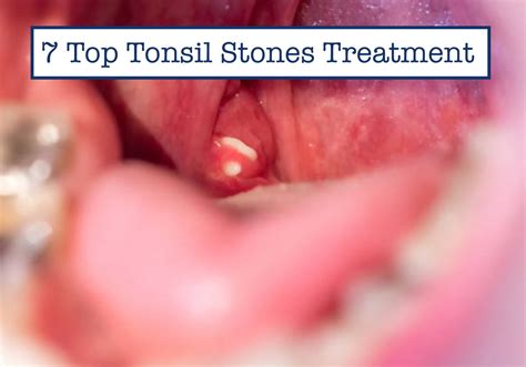 tonsil stones texture  ted hayes blog
