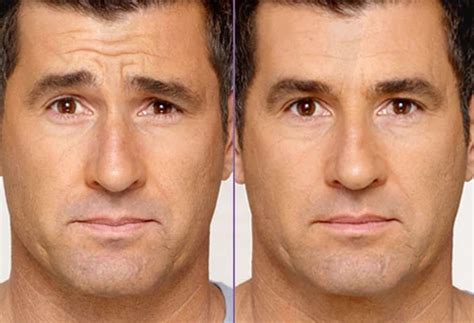 forehead seattle smiles dental