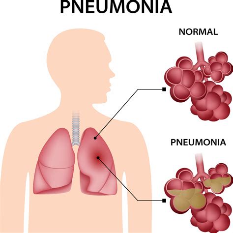 Pneumonia | Private Pneumonia Treatment | Respiratory London