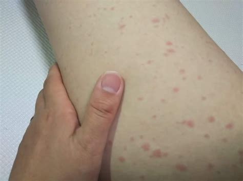 薬の副作用で初の薬疹。発生から対処法まで。 | 育児のつれづれ by 東京ダック