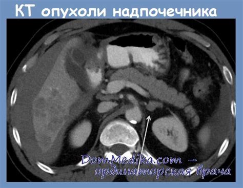 Случайно выявленная опухоль надпочечников - причины